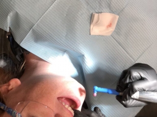 Coronal polishing and working on our fulcrum!